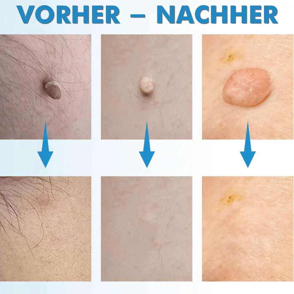 Warzenentferner Ergebnis nach 8 Tagen – abgeheilte Warze