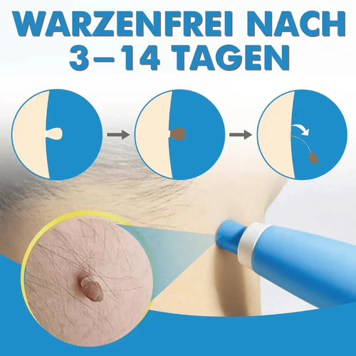 stielwarzenentferner-anwendung-haut